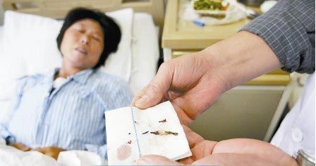 通過(guò)手術(shù)取出的針。　　商報(bào)記者 