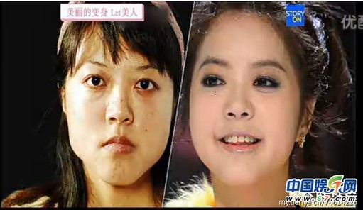 多圖劇透韓國整容節(jié)目《LET 美人》近幾期，最愛小V臉，人瘦就能美