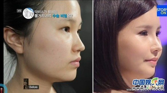 多圖劇透韓國整容節(jié)目《LET 美人》近幾期，最愛小V臉，人瘦就能美