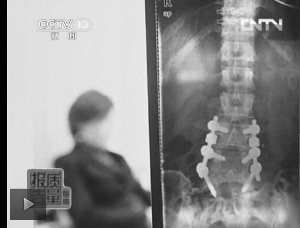 圖1：教練按壓導(dǎo)致學(xué)員腰椎間盤突出。（央視截屏）