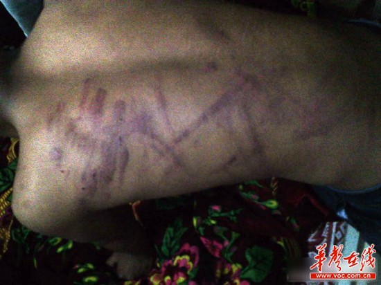網(wǎng)曝云南省富源縣一名老師持續(xù)4小時(shí)體罰學(xué)生，期間打斷5根電線。（圖為被體罰學(xué)生）網(wǎng)絡(luò)截圖