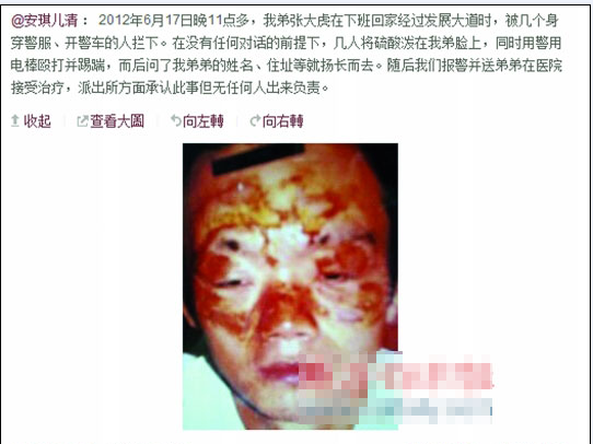 張大虎的姐姐將弟弟面部燒傷一事發(fā)上微博，引發(fā)網友廣泛關注。